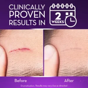 BQYOOM™ Advanced Scar Gel